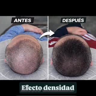 Antes y después real 🔥 
Resultados visibles con micropigmentación capilar 👌 
📍 Bogotá 
📲 Escríbe