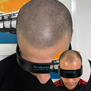 ANTES / DESPUÉS

Recuperamos la línea frontal y creamos un efecto de densidad totalmente natural.
Re