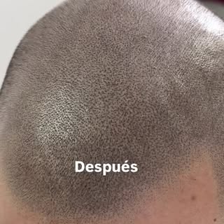 ✨ Resultados reales con Micropigmentación Capilar

✔️ Efecto rapado natural
✔️ Mayor definición de l