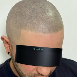 🔥 Micropigmentación capilar efecto rapado.

Definición, naturalidad y una línea frontal diseñada pa