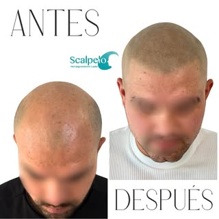 Con la micropigmentación capilar recreamos el efecto de folículo rasurado, dando densidad, definició
