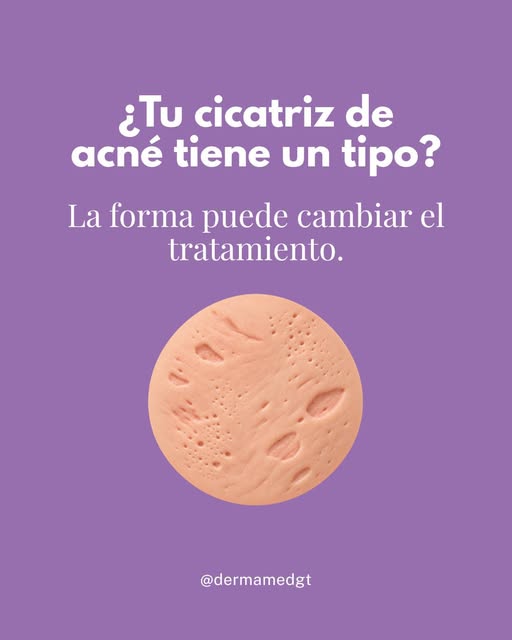 Dos personas pueden tener cicatrices de acné y necesitar tratamientos completamente diferentes.

¿Po