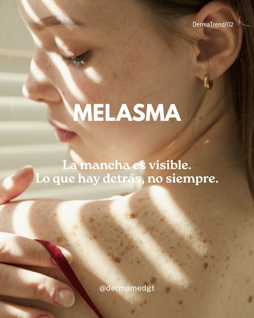 El melasma no es simplemente “una mancha”.

La exposición solar, factores hormonales y la predisposi