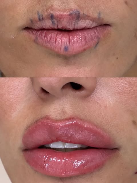 Preenchimento labial não precisa significar mais volume. Precisa fazer sentido. ✨

Neste caso, o obj