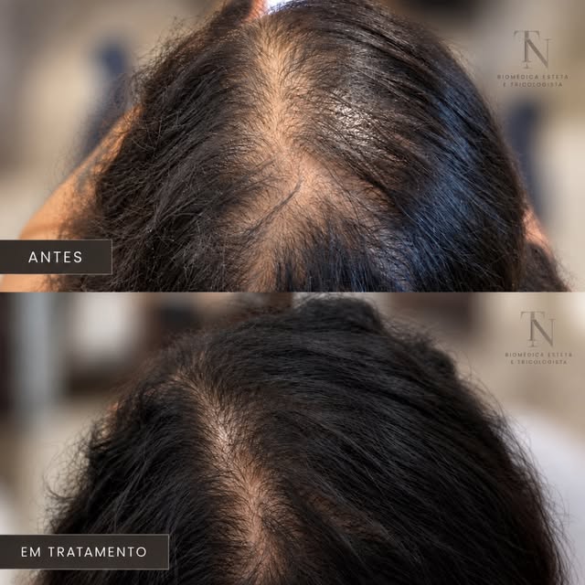 Quando a queda começa, a primeira pergunta costuma ser: “o que eu passo no cabelo?”
Mas, muitas veze