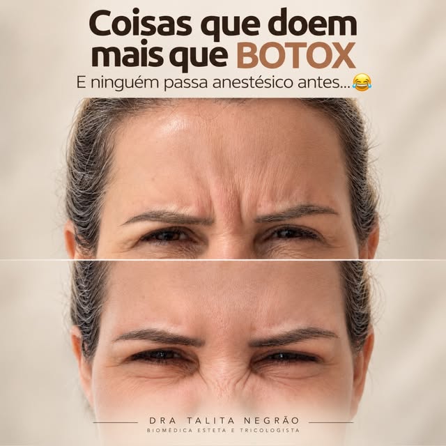 Tem coisa que dói mais que Botox… 😂

E uma delas é ouvir que toxina botulínica deixa todo mundo com