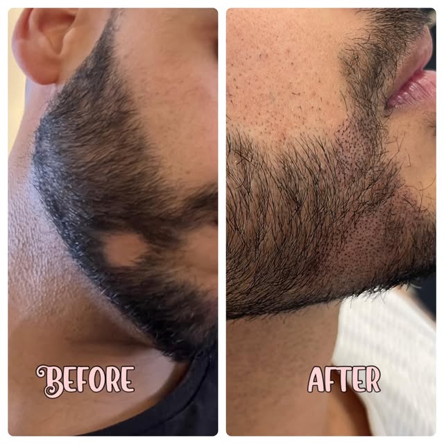 "Transform your look with Beard Scalp Micropigmentation! 👨✨ Say goodbye to gaps and hello to a full
