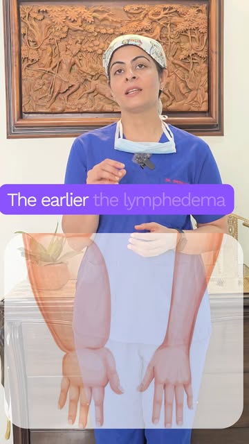 Swelling That Doesn’t Go Away? It Could Be Lymphedema.

Lymphedema happens when lymph fluid builds u
