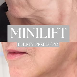 Minilift — subtelna zmiana, którą widać.

Efekt? Wyraźniej zaznaczona linia żuchwy, gładsza okolica 