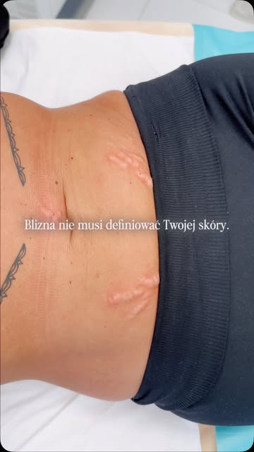 Blizna, która była z Tobą przez lata, nie musi wyglądać tak samo na zawsze.

Zobacz efekty terapii b