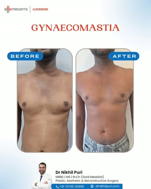 Gynaecomastia Treatment – Restoring a More Defined Chest

Gynaecomastia is the enlargement of male b