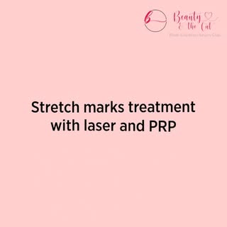 ✨ Say goodbye to stretch marks with the power of Laser & PRP treatments! ✨ Watch as we combine advan