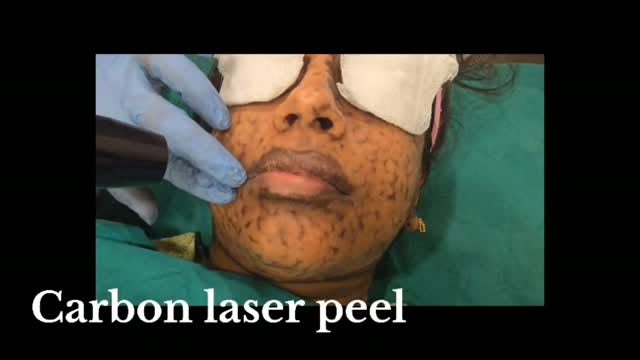 ✨ Glow. Refresh. Rejuvenate. ✨

A closer look at Dr. Kiranmayi Atla performing a Carbon Laser Peel —