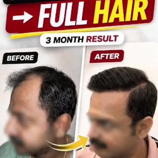 Real Confidence.
Hair Transplant transformation that speaks for itself.
If you’re struggling with ha