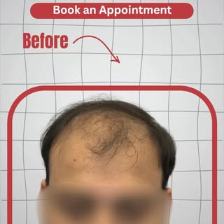 Real transformation. Real results. 
See this amazing Hair Transplant Before & After result at Pathak
