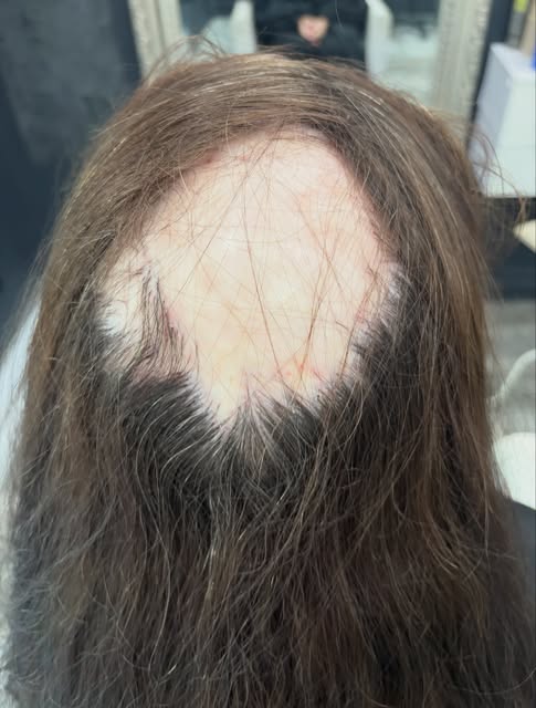 A scalp prosthesis can be life-changing because it’s about so much more than hair—it’s about confide