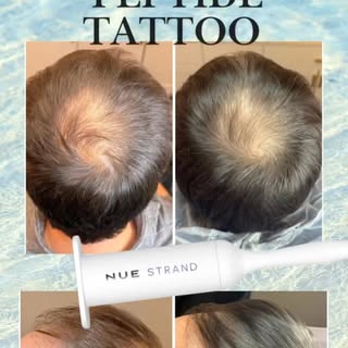 POV: if you started NUE STRAND 

A refined approach to hair restoration—supporting the scalp, nurtur