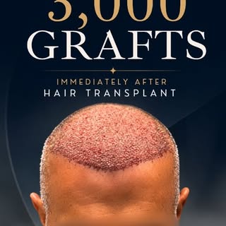 Every hair transplant begins with a personalised plan.
This patient received 3,000 grafts in a singl