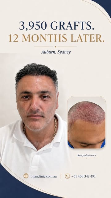 3,950 grafts. 12 months later.
This patient’s 12-month hair transplant result shows the progression 