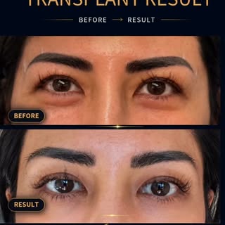 Natural eyebrow restoration with FUE eyebrow transplant at Bijan Clinic, Sydney.

This real patient 