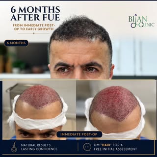 6 months after FUE hair transplant.

This case shows the journey from the immediate post-op stage to