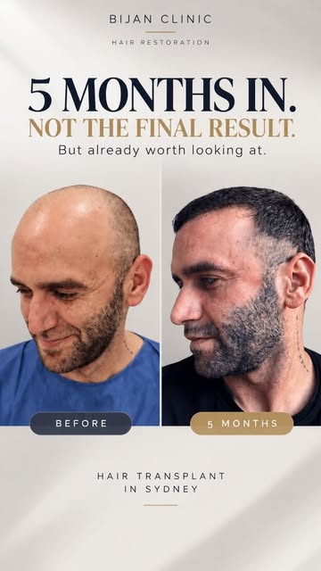 This patient is now 5 months into his hair transplant journey.
At this stage, the result is still ev