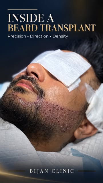 A closer look inside an FUE beard transplant at Bijan Clinic.

Every stage is carefully planned—from