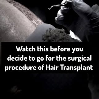 If you think hair transplant is the permanent solution for Baldness then you must think again!

Hair