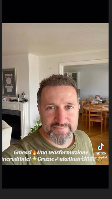 “Il tempo vola, ma il cambiamento resta! ⏳✨ Questo è il mio risultato a soli 6 mesi dal trapianto di