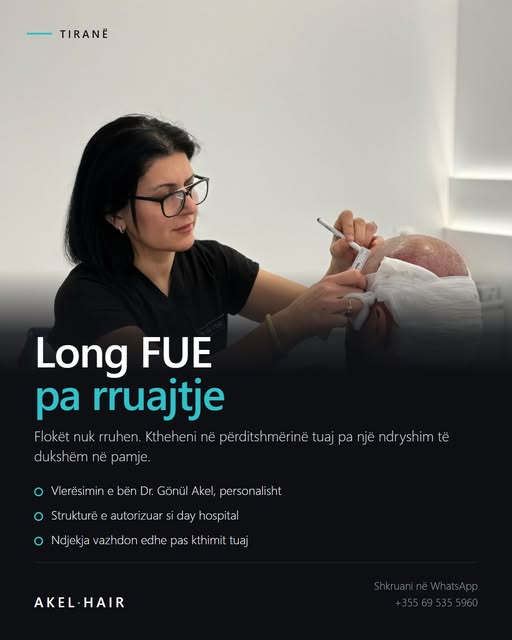 Long FUE — transplantim pa rruajtje të flokëve.

Çfarë do të thotë: flokët nuk rruhen, prandaj mund 
