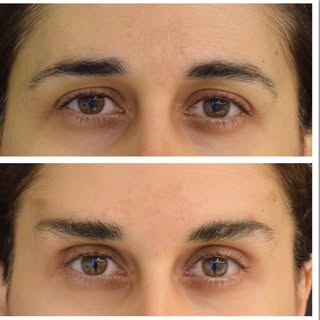 Browlift .
#brow #browlift #browlifting #drufukbilkay .
. Every surgical and interventional procedur