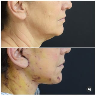 Deep plane face and neck lift. 7days after surgery.
. Every surgical and interventional procedure ca