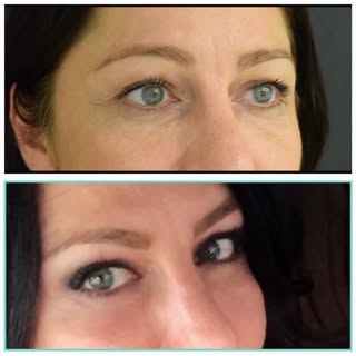 Upper and lower eyelid surgery.
#eyelid #eyelidsurgery #blefaroplasty #drufukbilkay .
. Every surgic