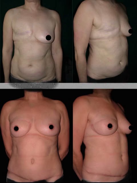 Breast reconstruction with patient’s own tissue after mastectomy due to breast cancer .
#breastrecon