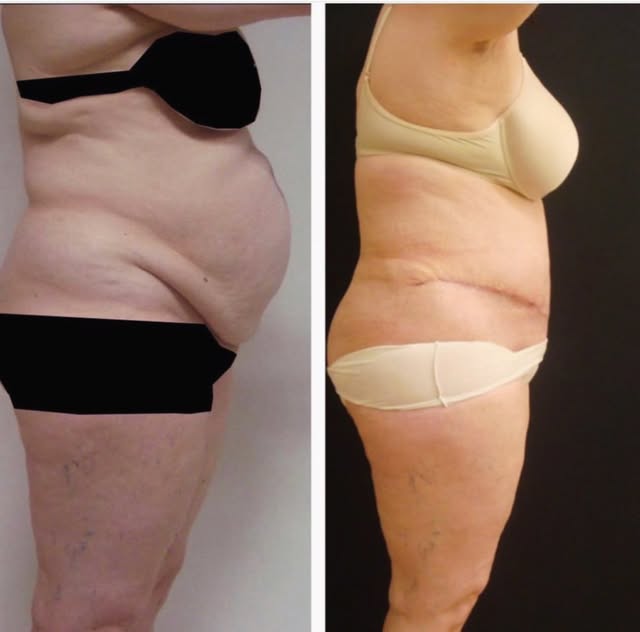 Tummy tuck and diastasis recti repair.
#tummy #tummytuck #liposuction #diastasisrecti #drufukbilkay 