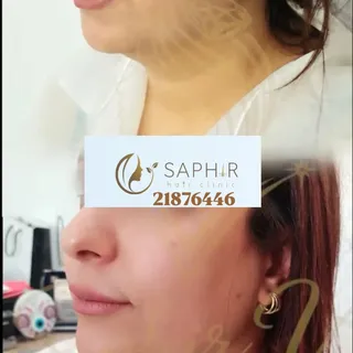 Un profil plus net commence par un contour du visage harmonieux.
Si le double menton vous gêne, une 
