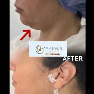 l’harmonie du visage et du profil.
Découvrez nos solutions esthétiques pour améliorer le contour du 