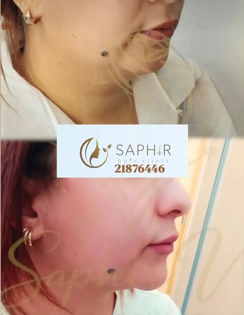 Le double menton peut modifier l’harmonie du visage et du profil. Grâce à une prise en charge esthét