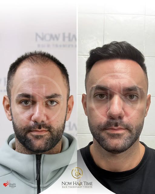 ✨ Hair Transplant | Before & After

🔬 Sapphire FUE + DHI - NW5
💉 5600 grafts
🗓️ Pre-op : November