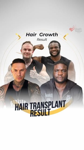 Balanced Planning, Considered Approach ✨
The hair transplantation process was planned by taking into