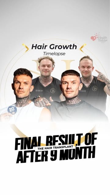 At Now Hair Time, hair transplantation is a carefully planned medical procedure, based on the existi