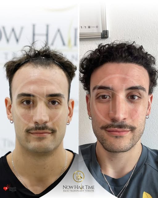 ✨Hair Transplant | Before & After

🔬 Technique: Sapphire FUE — NW2
💉 Grafts: 4500 grafts
🗓️ Pre-o