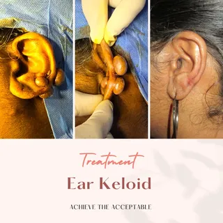 Keloid is a troubling problem. 
It happens due to abnormal healing pattern in some individuals. 
Ear