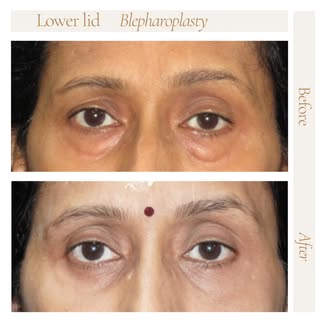 Lower eyelid blepharoplasty.. 😎
Lower eyelid bag removal. 
Take of the extra bag of tissues from th