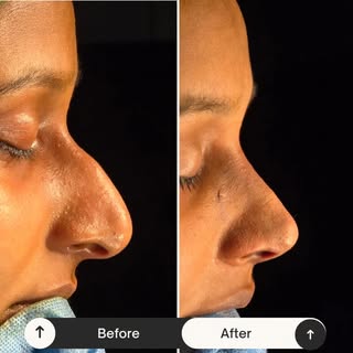 Indian rhinoplasty ❤️ 
Rhinoplasty results. ... immediate on table❤️
Closed rhinoplasty reduces the 