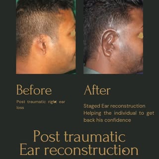 Ear reconstruction is considered to be one of the toughest plastic surgery. 
Here we want to showcas