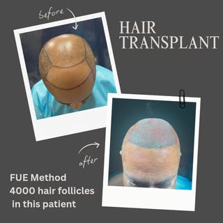 Hair transplant day.. 
The ultimate solution for baldness is hair transplant.  The transplanted hair
