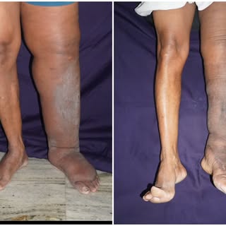 Lymphoedema of lower limb is really atrouble maker. With advanced plastic surgery treatment options 