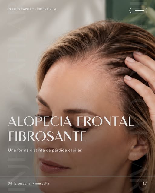 🔍 ¿Notas que la línea frontal del pelo se ha ido desplazando hacia atrás o que has perdido densidad