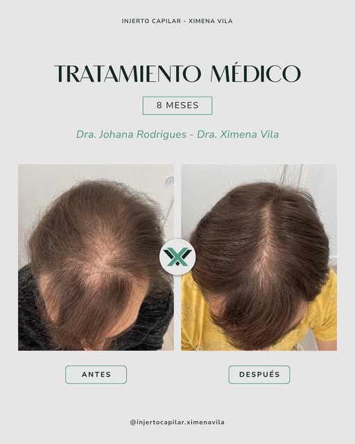 🩺 Seguridad médica y resultados visibles en alopecias avanzadas.

Incluso en grados elevados de alo